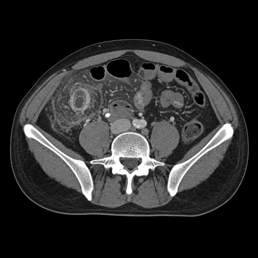 NOS EMR CT Appendicitis 예시