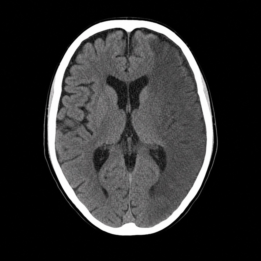 NOS EMR CT Stroke 예시
