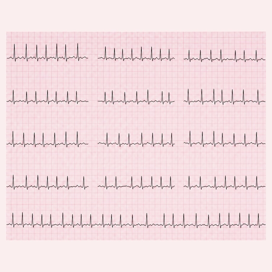 NOS EMR ECG A-fib 예시