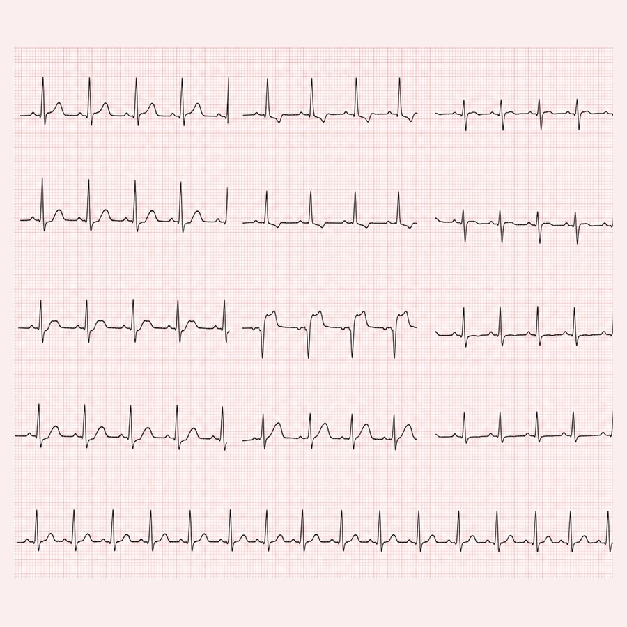NOS EMR ECG STEMI 예시