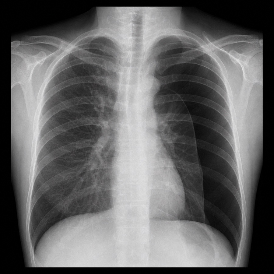 NOS EMR X-ray Pneumothorax 예시